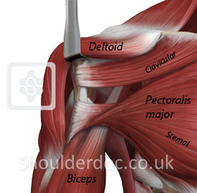 Pectoralis Major Transfer ShoulderDoc